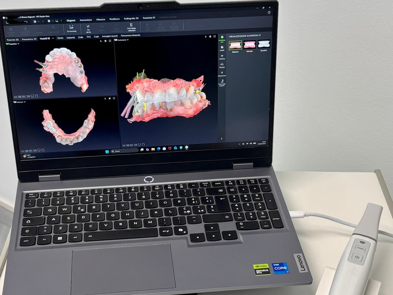Lo scanner intraorale dello studio accanto al computer, con una scansione 3D delle arcate